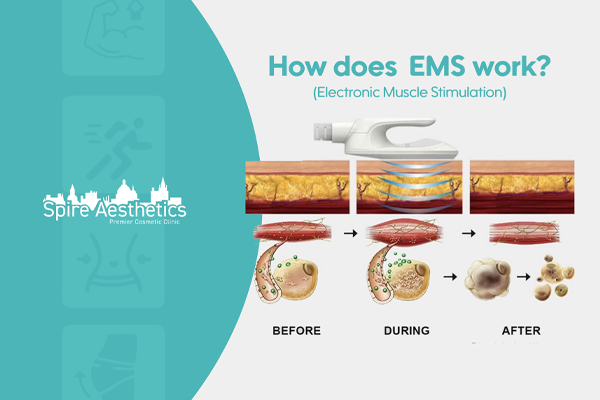EMS treatment for post pregnancy weight loss treatment Ross-on-Wye