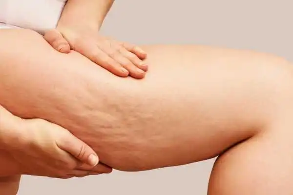 Image of woman showing leg with cellulite Ross-on-Wye