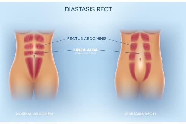 What Non-Surgical Options Are Available for Diastasis Recti Ross-on-Wye?