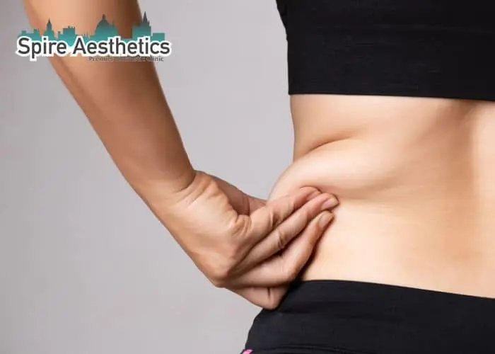 Image of woman pinching fat on their hips Ross-on-Wye. Fat Freezing treatment