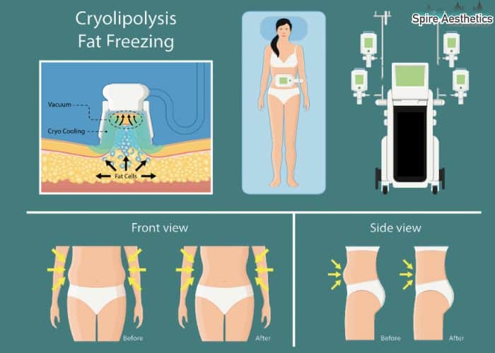 Image of diet and fat freezing combined for best results for Spire Aesthetics Ross-on-Wye