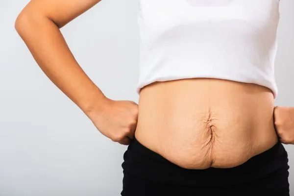 Image of a woman's stomach after weight loss with sagging skin following a gastric band Ross-on-Wye