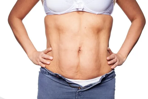 sagging skin on woman's stomach after weight loss injections Ross-on-Wye
