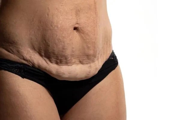 Image of womans stomach after weight loss injections Ross-on-Wye showing saggy skin