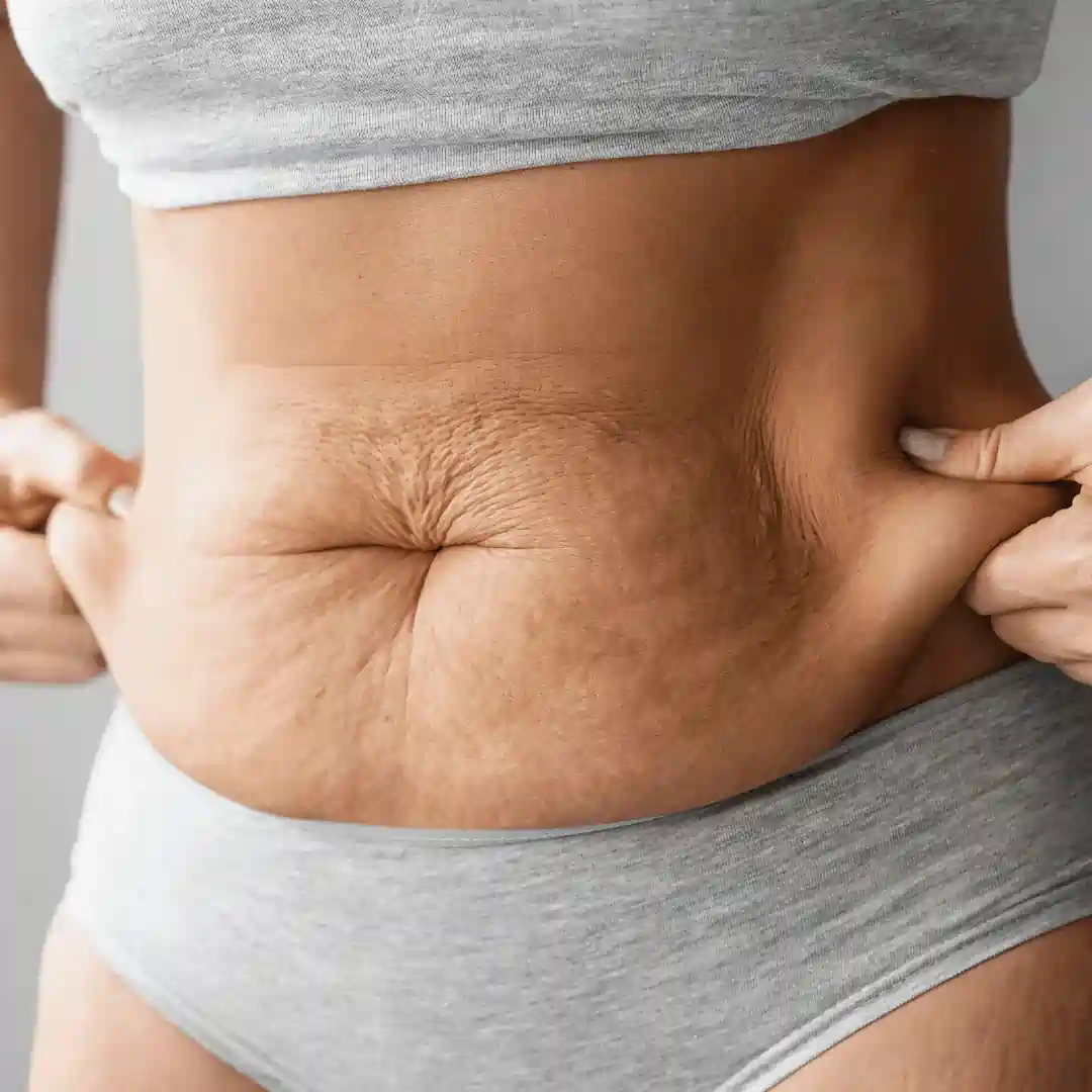 Is It Normal to Have Loose Skin After Pregnancy Ross-on-Wye?