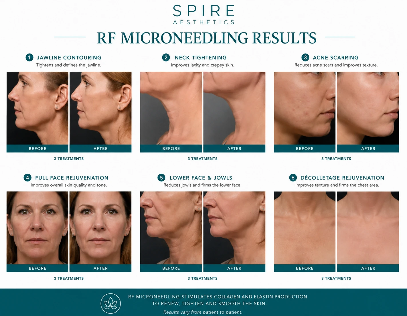 RF Microneedling Skin tightening Ross-on-Wye results