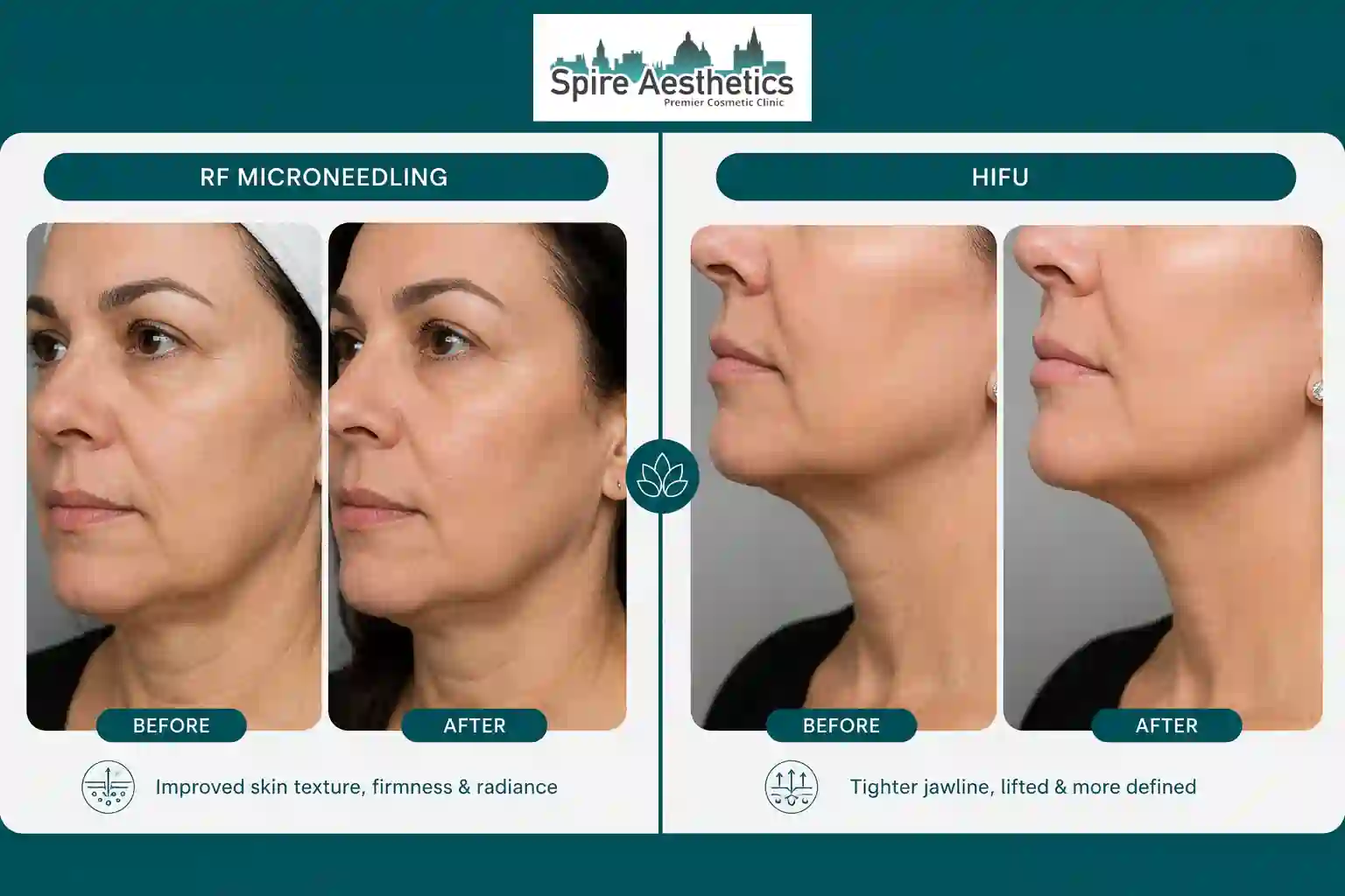 Can RF Microneedling and HIFU Be Combined Ross-on-Wye?