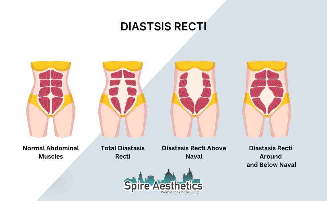 Is Non-Surgical Diastasis Recti Treatment Right for You? Common Concerns Answered Ross-on-Wye